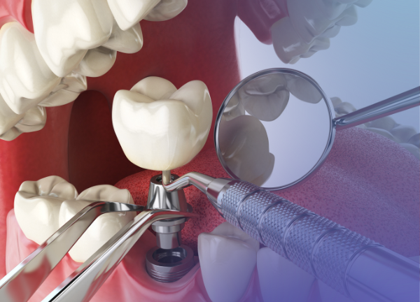 implantes1 (2) implantes1 (2)