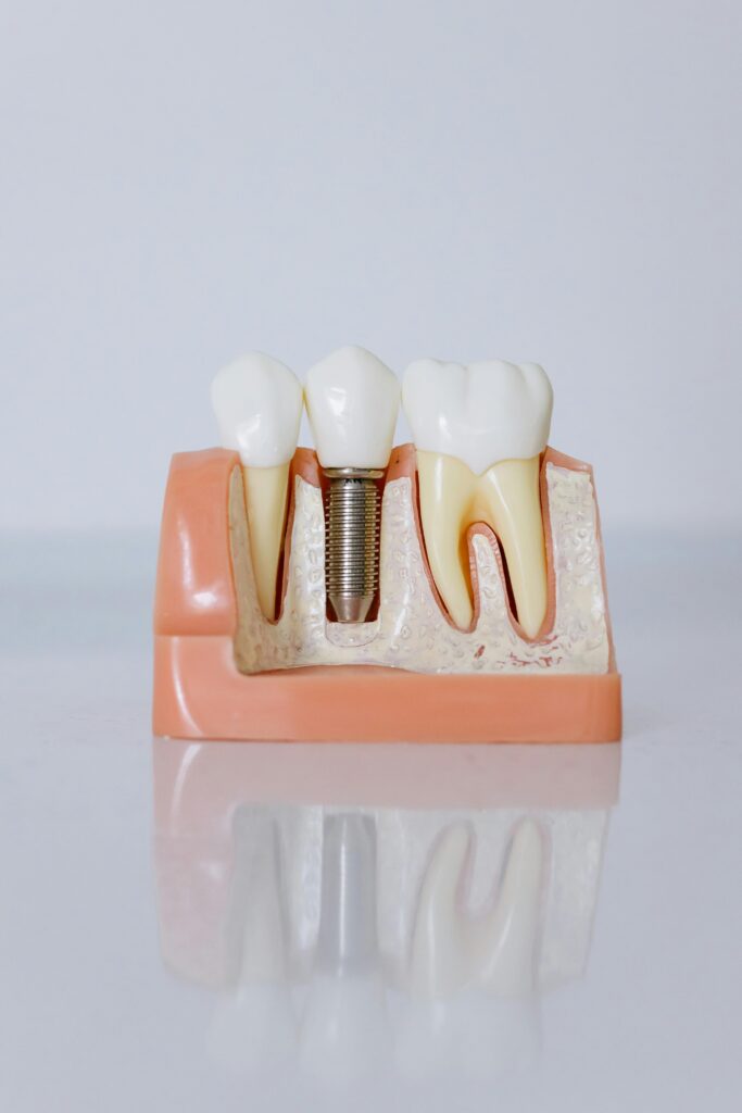 pexels photo 6502306 6502306 Detailed view of a dental implant model showcasing teeth and gum anatomy for dental education.